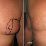 Smart-Lipo Male Breast Reduction